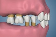 Loss of Posterior Occlusion